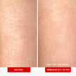 First Aid Beauty - KP Bump Eraser Body Scrub with 10% AHA, Keratosis Pilaris Skin Exfoliator with Glycolic and Lactic acids, Helps Reduce Chicken Skin Bumps, Safe for Sensitive Skin, 8 oz