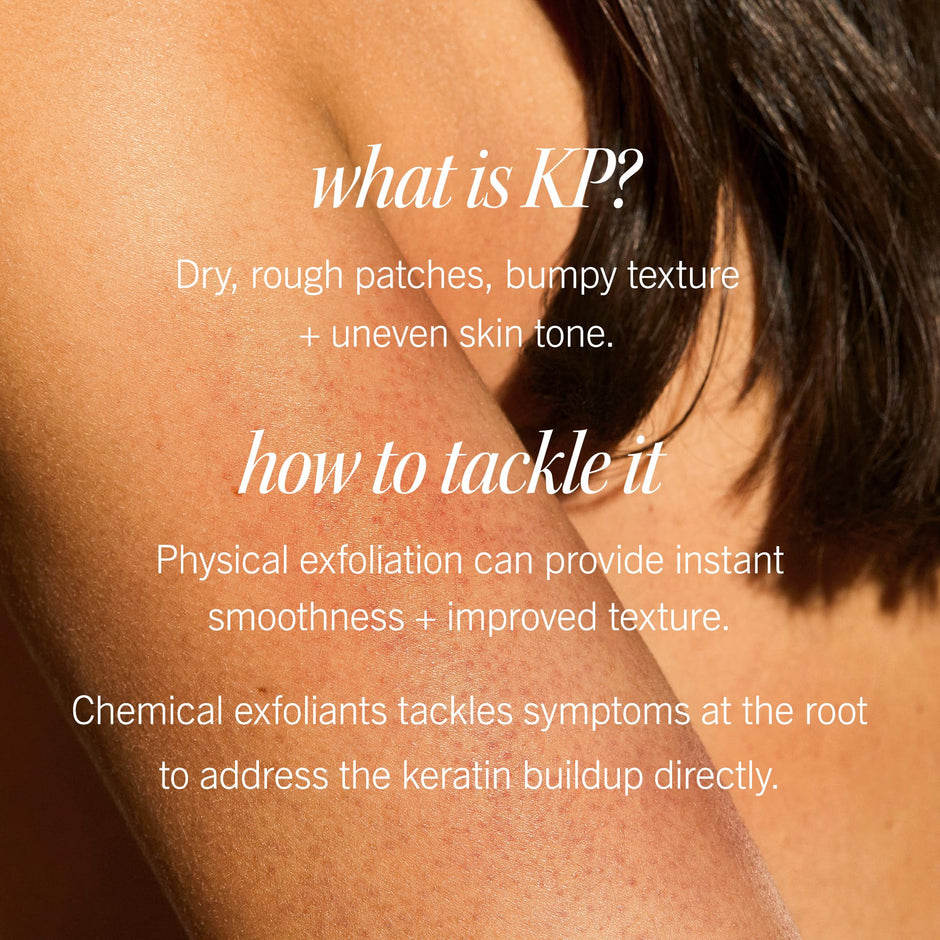 First Aid Beauty - KP Bump Eraser Body Scrub with 10% AHA, Keratosis Pilaris Skin Exfoliator with Glycolic and Lactic acids, Helps Reduce Chicken Skin Bumps, Safe for Sensitive Skin, 8 oz