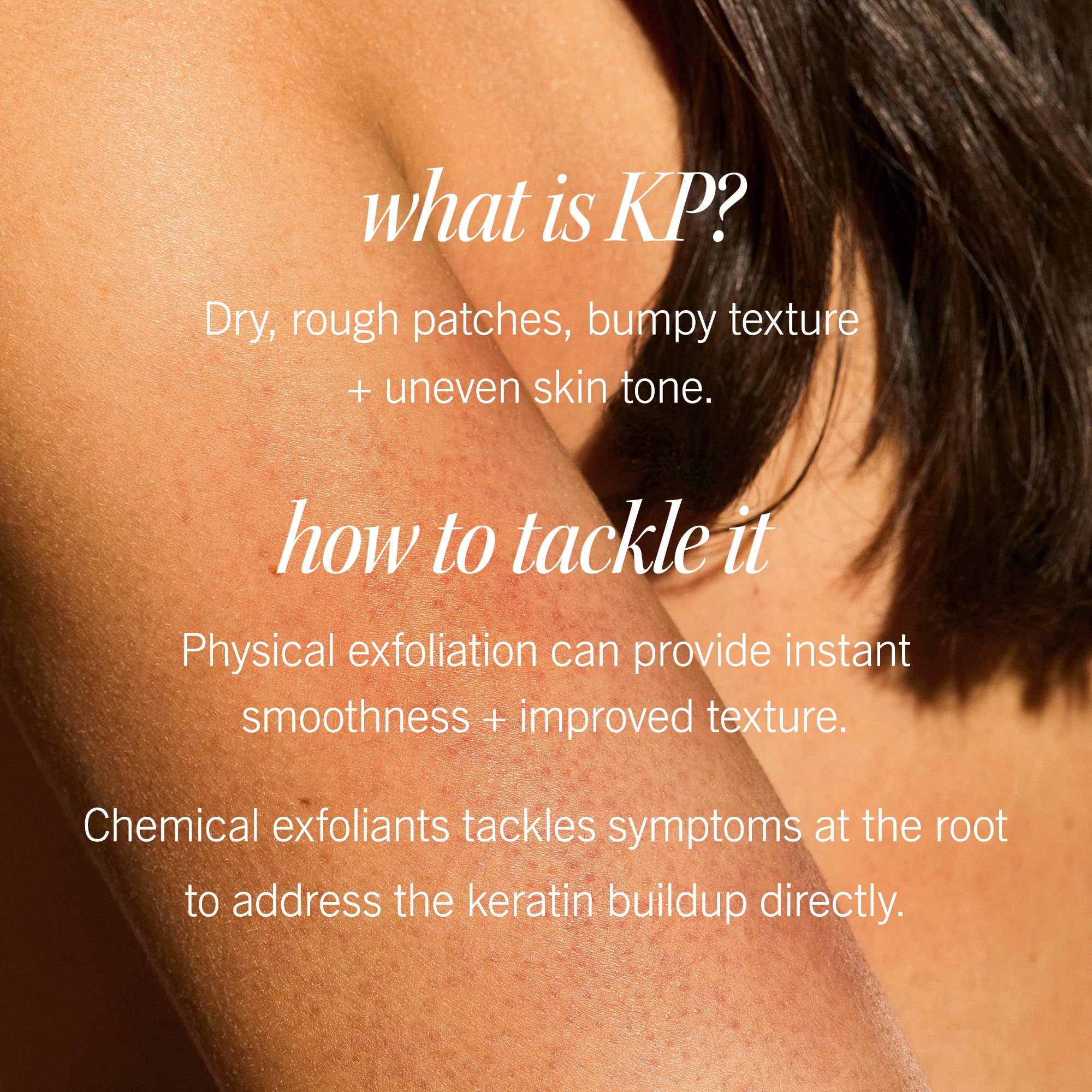 First Aid Beauty - KP Bump Eraser Body Scrub with 10% AHA, Keratosis Pilaris Skin Exfoliator with Glycolic and Lactic acids, Helps Reduce Chicken Skin Bumps, Safe for Sensitive Skin, 8 oz